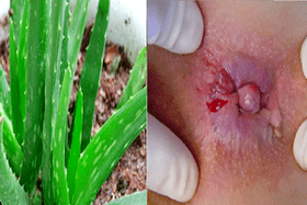 Aloe für die Behandlung von Hämorrhoiden