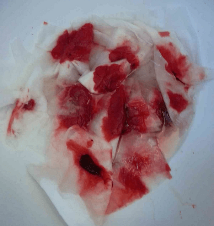 Blutung mit Hämorrhoiden