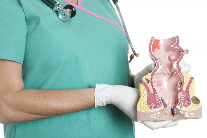 Der Arzt demonstriert das Hämorrhoidenmodell