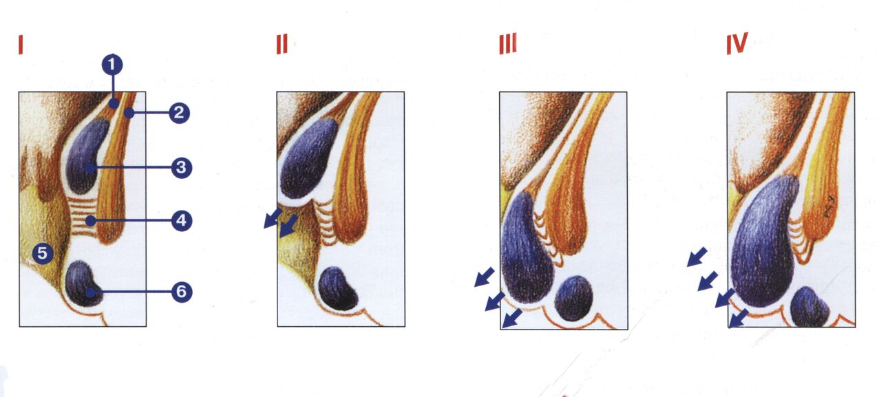 Stadien der Hämorrhoidenentwicklung