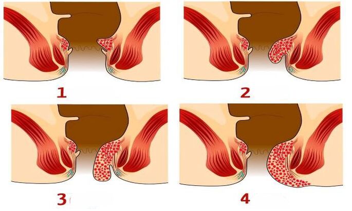 wie Hämorrhoiden in verschiedenen Stadien aussehen